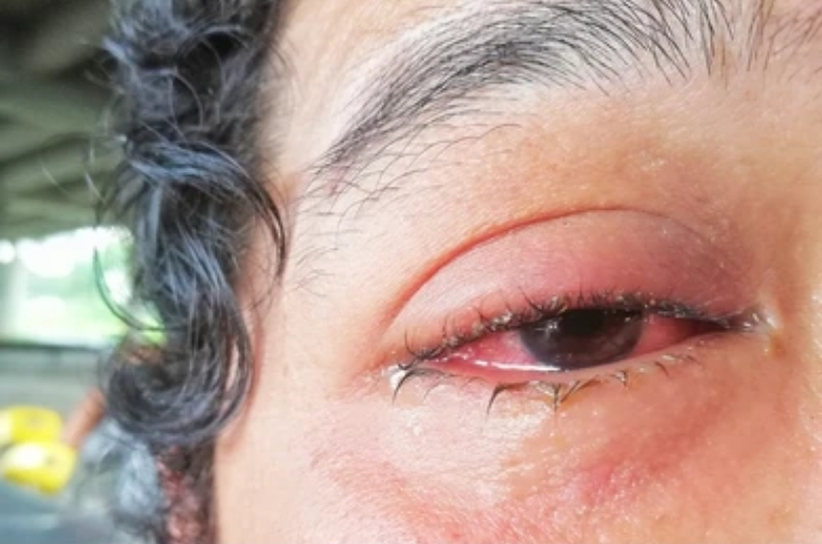 Conjunctivitis-15.jpg